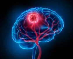Turomi cerebrali, per la cura in arrivo nuovo farmaco biologico