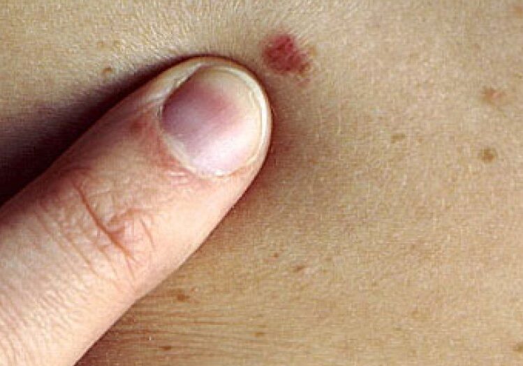 Salute: sabato a Milano con il dottor Abatangelo il terzo congresso di dermatochirurgia oncologica