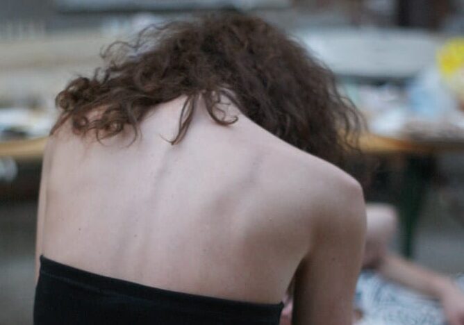 L’allarme anoressia nelle giovani donne: migliaia di casi ogni anno