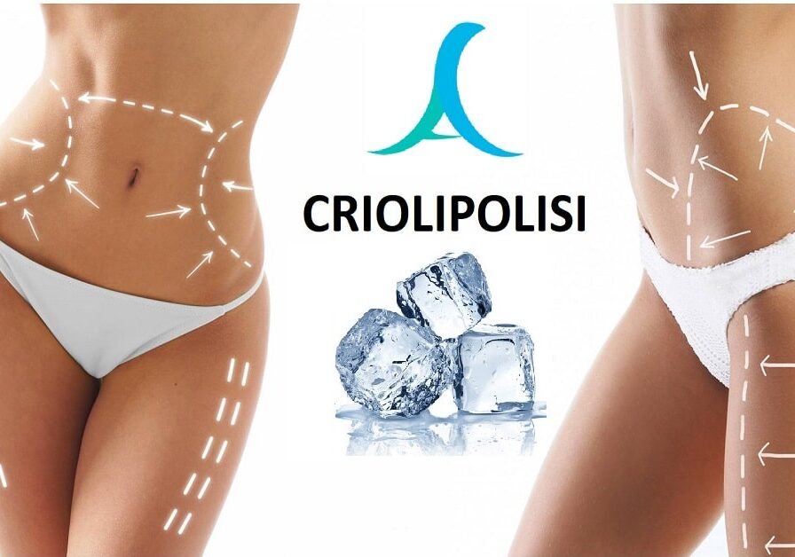 Open Day sulla Criolipolisi: sabato 22 a Bareggio incontro informativo sulla riduzione del grasso localizzato